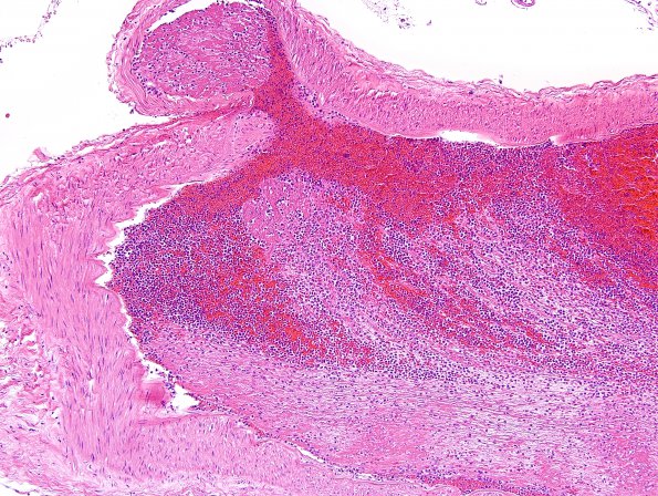 5B2 Infarct, 1day (Case 5) H&E 14