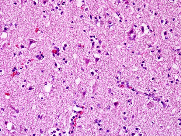 5B4 Infarct, 1day (Case 5) H&E 19