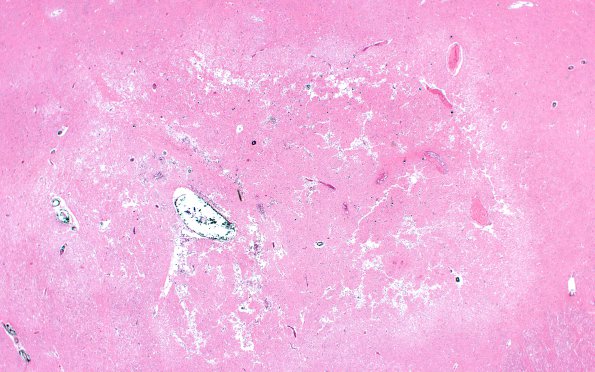 6B2 Case 6 GP lesion L17 H&E 2X