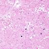 6B3 Infarct, acute (Case 6) H&E 1 A