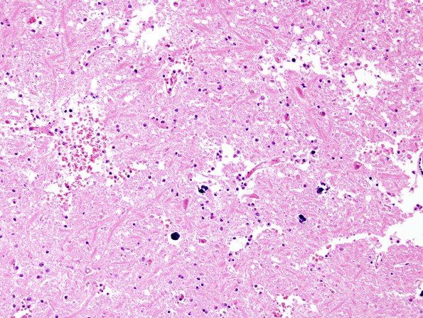 6B3 Infarct, acute (Case 6) H&E 1 A