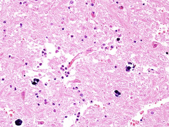 6B5 Infarct, acute (Case 6) H&E 2 A