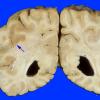 7A1 Infarct, acute (Case 7) 2 copy