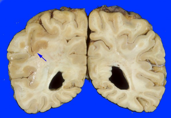 7A1 Infarct, acute (Case 7) 2 copy