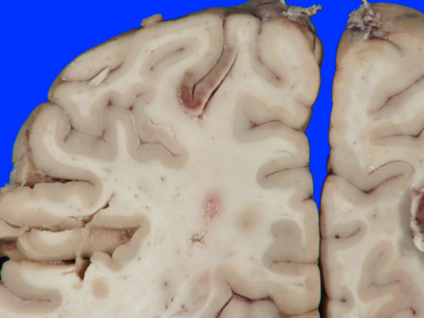 8A1 Infarct, acute (Case 8) 7