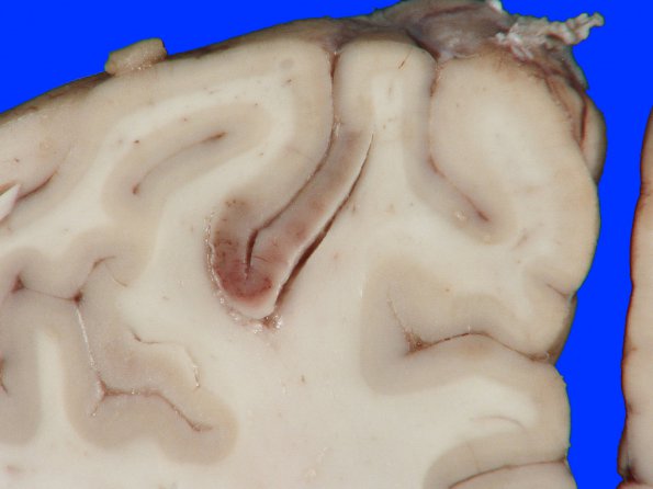 8A2 Infarct, acute (Case 8) 8