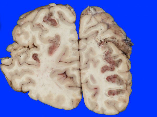 8A3 Infarct, acute (Case 8) 9