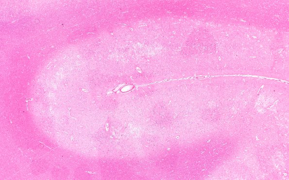 8B2 Infarct, acute (Case 8) N5 H&E 2X9