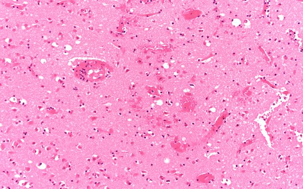 8B4 Infarct, acute (Case 8) N17 H&E 20X