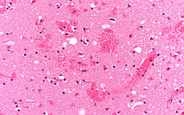 8B5 Infarct, acute (Case 8) N17 H&E 40X