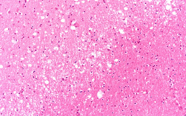 8C2 Infarct, acute (Case 8) N20 H&E 20X