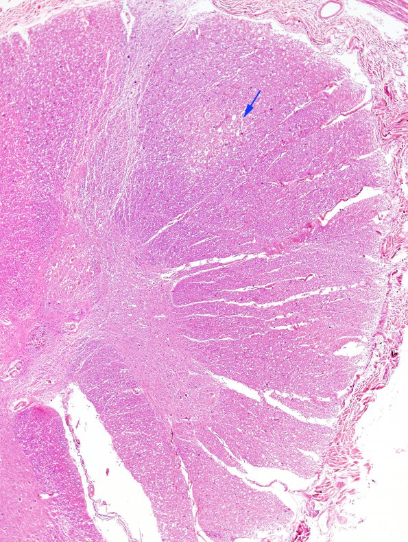 9A1 Infarct, adjacent to, acute (Case 9) H&E 2 copy