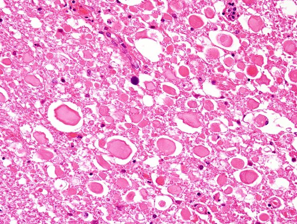 9A3 Infarct, adjacent to, acute (Case 9) H&E 4