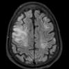 1A1 Air embolism (Case 1) FLAIR 1 - Copy