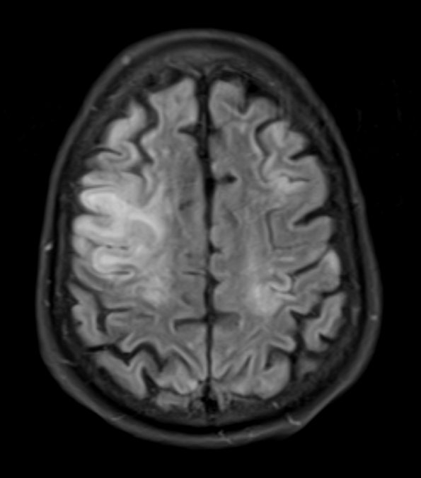 1A1 Air embolism (Case 1) FLAIR 1 - Copy