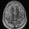 1A2 Air embolism (Case 1) T2 - Copy