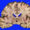 1B Embolism, air (Case 1)_3 copy