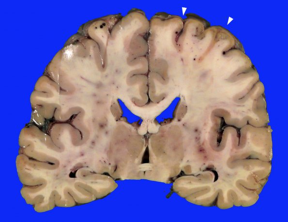 1B Embolism, air (Case 1)_3 copy