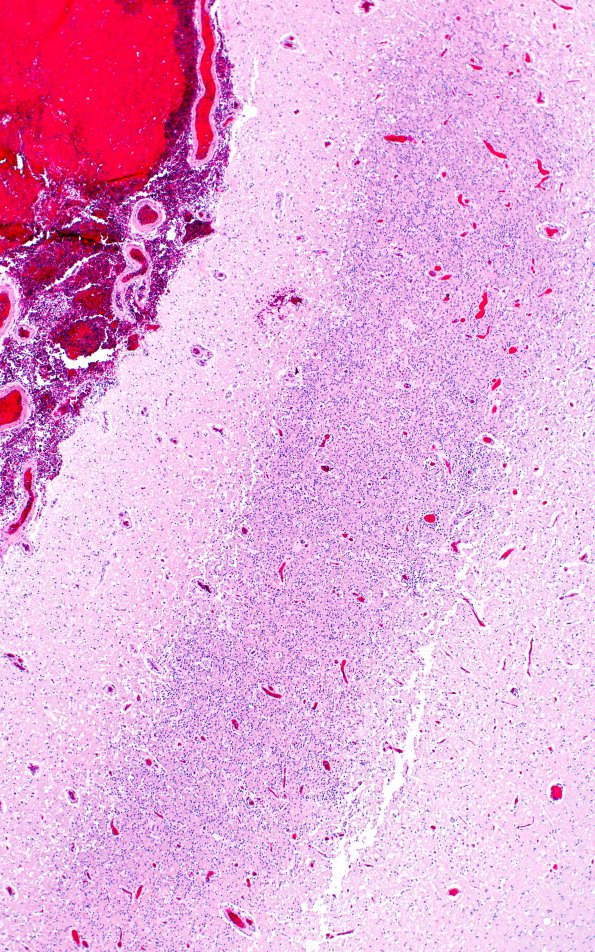 1C2 Embolism, air (Case 1) N1 H&E 4X