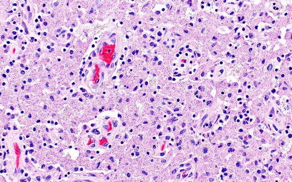 1C3 Embolism, air (Case 1) N1 H&E 20X Ca 1