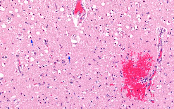 1C4 Embolism, air (Case 1) N16 H&E 2 copy