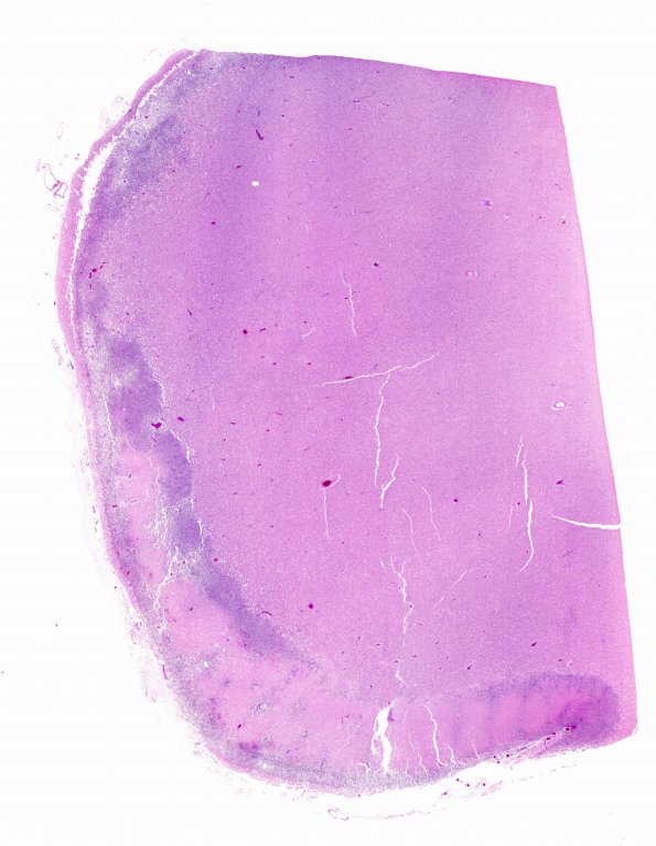 1C5 Embolism, air (Case 1) N13 H&E WM