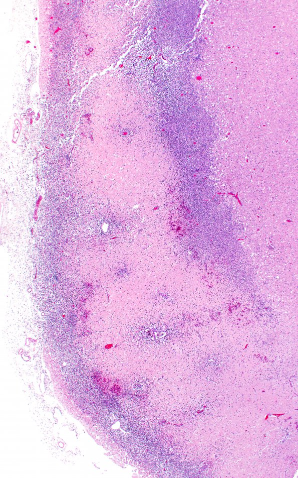 1C6 Embolism, air (Case 1) N13 H&E 2X