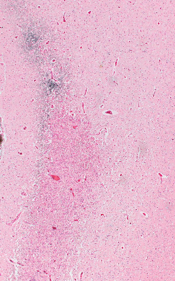 1E2 Embolism, air (Case 1) N1 Von Kossa 4X