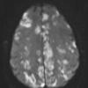 2A1 Embolism, air (Case 2) TRA DIFFUSION W 1 - Copy