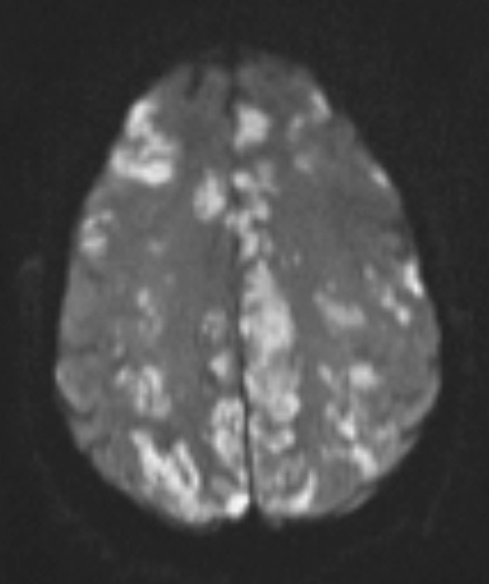 2A1 Embolism, air (Case 2) TRA DIFFUSION W 1 - Copy