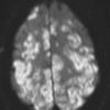 2A2 Embolism, air (Case 2) TRA DIFFUSION W 2 - Copy