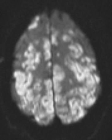 2A2 Embolism, air (Case 2) TRA DIFFUSION W 2 - Copy