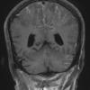 2A3 Embolism, air (Case 2) T1 W 1 - Copy