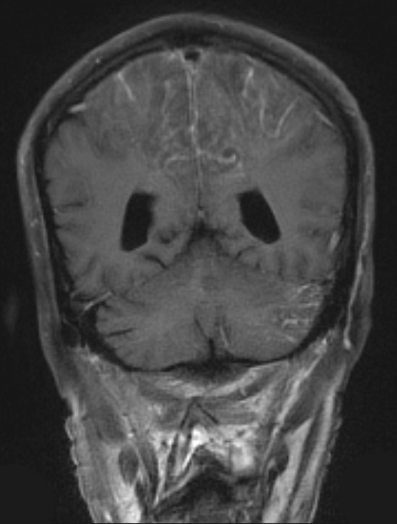 2A3 Embolism, air (Case 2) T1 W 1 - Copy