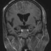 2A4 Embolism, air (Case 2) T1 W 3 - Copy