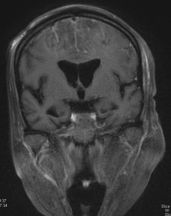 2A4 Embolism, air (Case 2) T1 W 3 - Copy