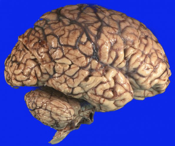 2B1 Embolism, air (Case 2) _2