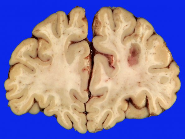 2B2 Embolism, air (Case 2) _4