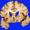 2B3 Embolism, air (Case 2) _6