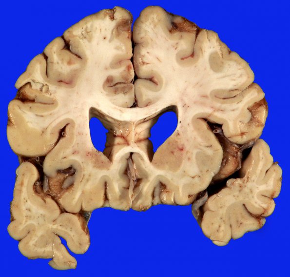 2B3 Embolism, air (Case 2) _6