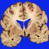 2B4 Embolism, air (Case 2) _8