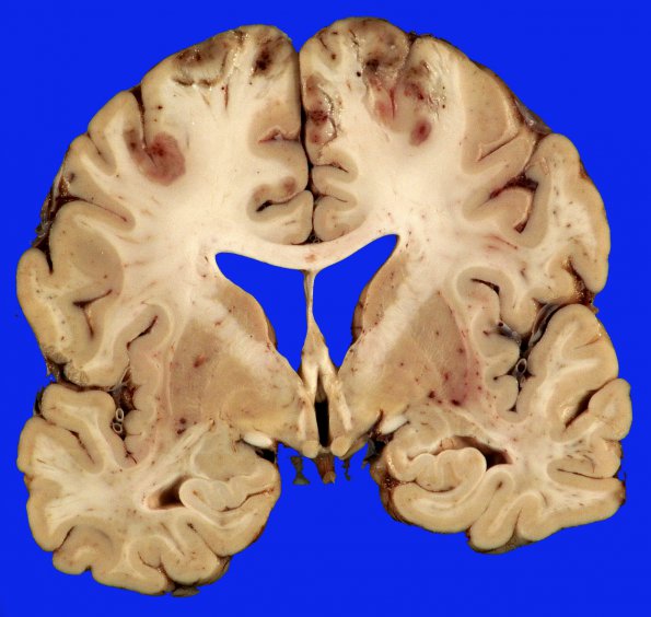 2B4 Embolism, air (Case 2) _8