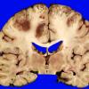 2B5 Embolism, air (Case 2) _10