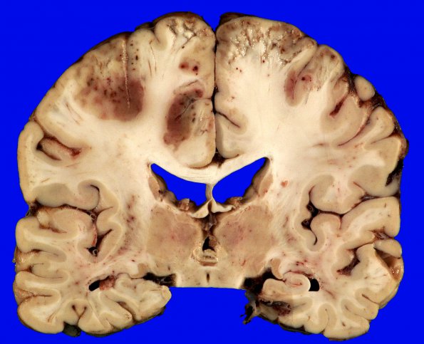 2B5 Embolism, air (Case 2) _10