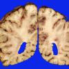 2B6 Embolism, air (Case 2) _13