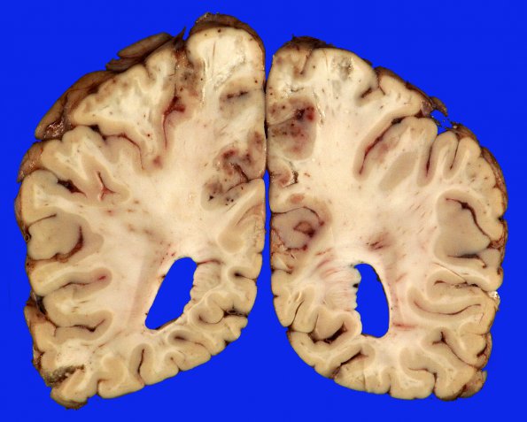 2B6 Embolism, air (Case 2) _13