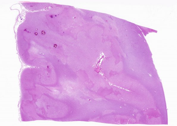 2C1 Embolism, air (Case 2) N15 H&E whole mount