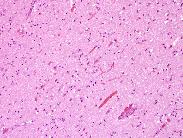 2C3 Embolism, air (Case 2) N15 H&E 1.j