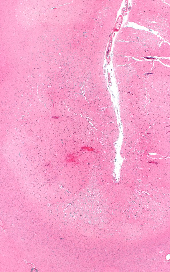 2C4 Embolism, air (Case 2) N11 H&E 2X