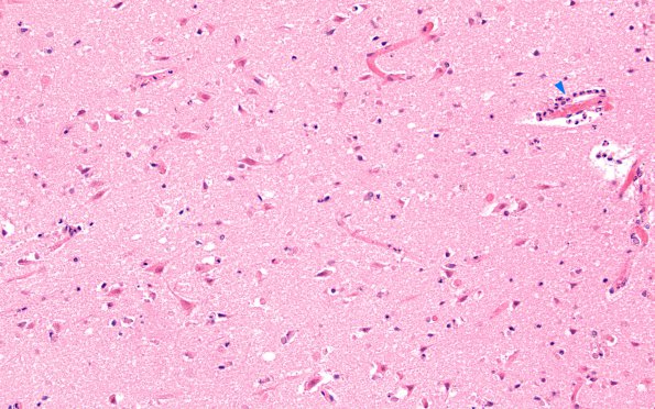 2C5 Embolism, air (Case 2) N11 H&E 20X copy